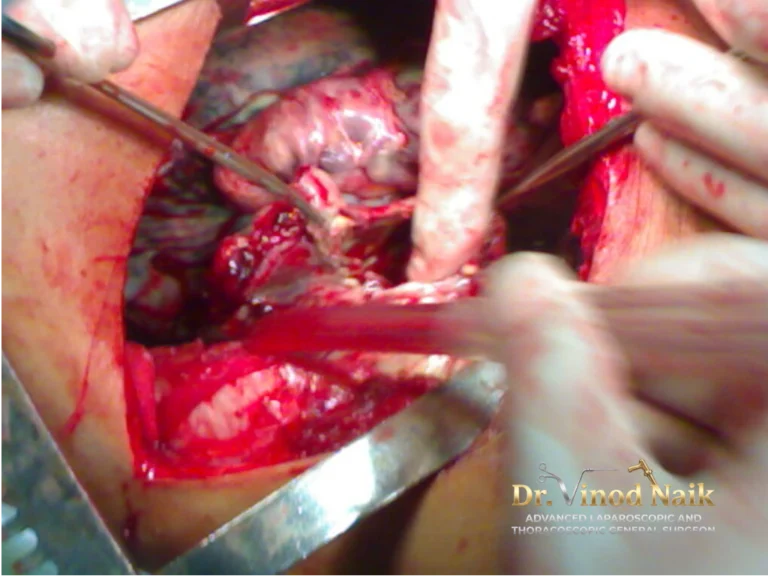 POSt ICD BPF PHOTO 1