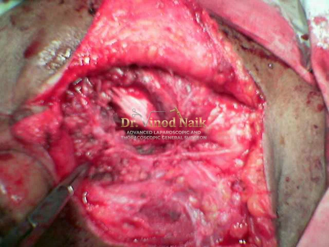 Parotidectomy3