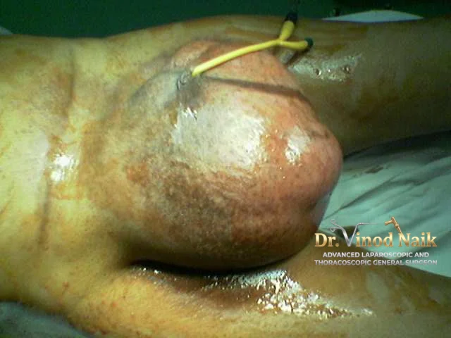 hernia 2